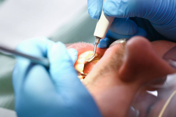 Best Emergency Tooth Extraction in USA